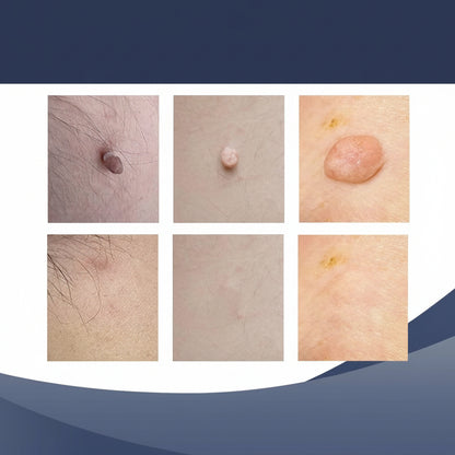 Éliminateur de verrues ensemble soin de la peau